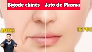 Como eliminar bigode chinês com jato de plasma [upl. by Kwan]