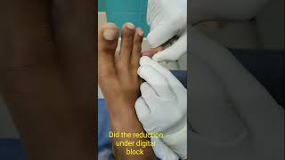 Toe Dislocation Emergency reduction  Toe injuries treatment  Adamya Hosp Videos [upl. by Sidra568]