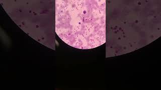 High platelet count platelets clumps  mega platelets  blood smear  mltwithmasood9010 [upl. by Llydnek]