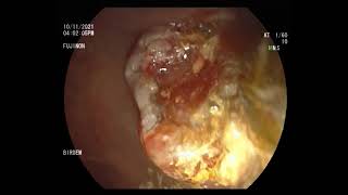 choledocholithiasis with cholangitis stone extraction [upl. by Karab]