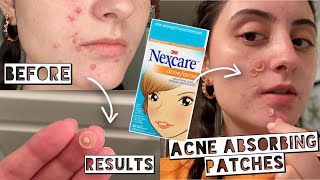 TESTING NEXCARE ACNE ABSORBING PATCHES FOR MY ACNE  Hydrocolloid Patches Results [upl. by Navac]