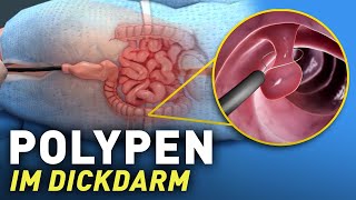 Entfernung von Polypen aus dem Dickdarm verstehen Polypektomie [upl. by Alysoun]