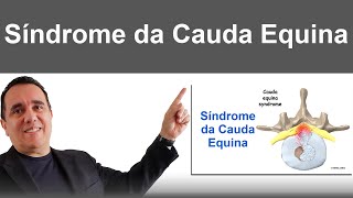 Síndrome da Cauda Equina [upl. by Anayi]