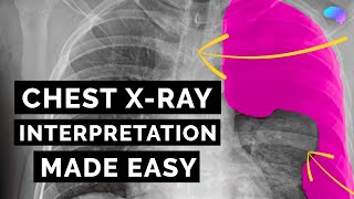 Chest Xray Interpretation  How to Read a CXR  OSCE Guide  UKMLA  CPSA [upl. by Eatnhoj]