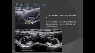 Pubalgie  aspects radiologiques [upl. by Romalda]