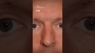 Upper blepharoplasty shorts [upl. by Valente942]