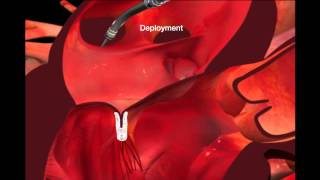 Mitral clip voice animation [upl. by Naehgem]