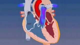 Atrial Septal Defect [upl. by Osbourn]