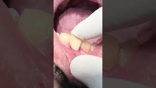 Part 10 Tooth fracture needs extraction and replace with implantdentist dental teethtoothless [upl. by Eilyw]