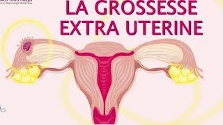 GYNECOLOGIE Grossesse extrautérine  les signes à connaître et la conduite à tenir [upl. by Kcirddec]