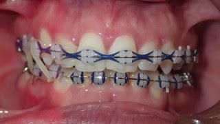 Orthodontic Transformation from Start to Finish [upl. by Lahey]