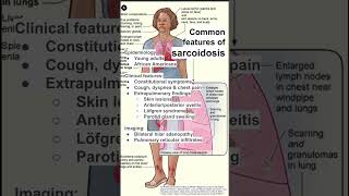 Common features of sarcoidosis [upl. by Link]