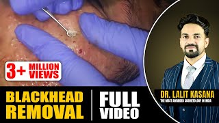 BLACKHEAD REMOVAL FULL VIDEO [upl. by Hayton]