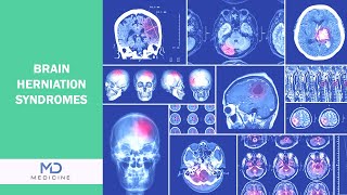 Brain Herniation syndromes Types Symptoms and Treatment [upl. by Letsyrc59]