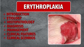 Erythroplakia  Erythroplakia Best Lecture Erythroplakia in depth [upl. by Kimberley]