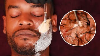 ያልተፈለገ ፀጉርን የማጥፊያ ህክምናዎች  Hair removal Methods  Dr Seife [upl. by Nahsab42]