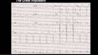 1215 Lead ECG MI Imposter 3 [upl. by Allistir]