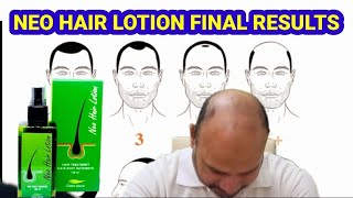 Neo Hair Lotion Minoxidil Final Results After 2 Yars [upl. by Ainerol599]