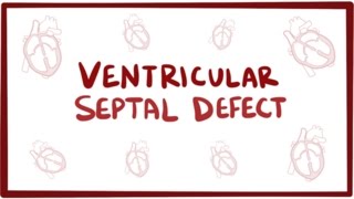 Ventricular septal defect VSD  repair causes symptoms amp pathology [upl. by Onibag]