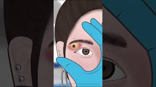 ASMR Infected Eyebrow piercing removalasmr animation viral trending shorts [upl. by Syramad748]