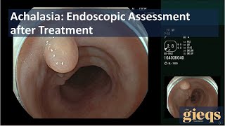 Achalasia Endoscopic Assessment after Treatment [upl. by Dinsmore988]