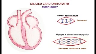 Dilated cardiomyopathy [upl. by Tatman]