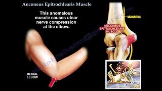 Anconeus Epitrochlearis Muscle cubital tunnel  Everything You Need To Know  Dr Nabil Ebraheim [upl. by Deck]