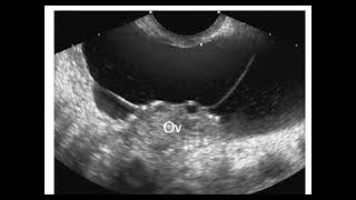 Peritoneal inclusion cyst [upl. by Ardehs636]