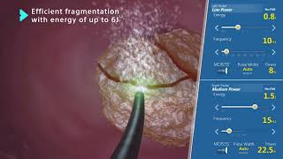 MOSES™ 20 Technology Holmium Laser for Lithotripsy Animation [upl. by Anneh]