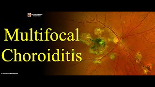 Multifocal Choroiditis [upl. by Hailee]