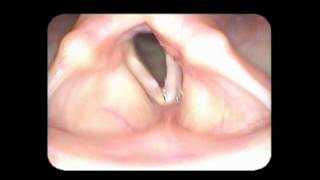 Vocal cord paralysis with nodules [upl. by Ria]