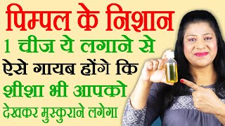 पिंपल के दाग कैसे हटाए  pimple ke daag kaise hataye  how to remove pimple marks [upl. by Karlin]