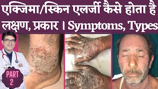 एक्ज़ेमा Symptoms In Hindi  Eczema Types with Pictures  लक्षण और प्रकार  Dermatologist  Jaipur [upl. by Aix119]