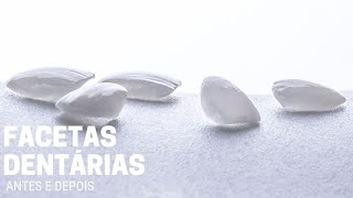 Facetas dentárias e a mudança de visual da Sónia  Clínica Hugo Madeira [upl. by Amalburga]