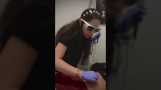 Laser Scar removal scarremoval dfwlasertreatment skinlightening belly texas hyperpigmentation [upl. by Faust]