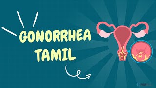 Gonorrhea in Tamil Definition Symptoms Causes Diagnosis and Management [upl. by Rubetta]