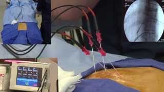 Radiofrequency Ablation Explanation Video Demonstration  LIVE [upl. by Vieva]