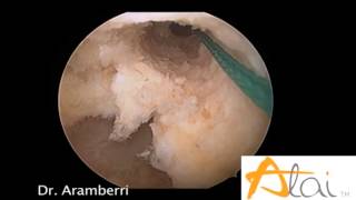 Rotura de ligamento cruzado anterior Artroscopia ACL tear Arthroscopy [upl. by Giah]