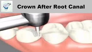 Dental Crown Procedure After Root Canal [upl. by Yrol915]