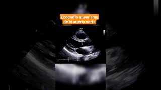 ANEURISMA DE LA ARTERIA AORTA ECOGRAFÍA ABDOMINAL [upl. by Turino732]