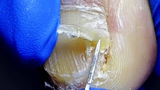 Professional ingrown toenail trimming to the right shape [upl. by Aziaf645]