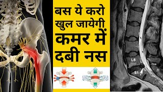 बस ये करो ठीक हो जाएगी कमर में दबी नस  L4L5 disc Bulge  SCIATICA  DABI NAS  leg pain  Hip pain [upl. by Aeriell781]