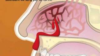 Epistaxis [upl. by Schuman]