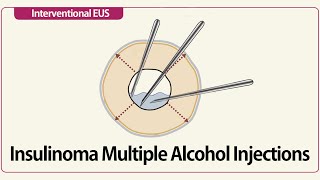 Linear EUS Insulinoma Multiple Alcohol Injections [upl. by Tiphanie]