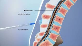 Lumbar Puncture 101  Understanding Study Procedures in ALS Clinical Trials [upl. by Furlani]