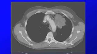 GRACEcast026LungCancerSilvestri on Diagnosis and Staging [upl. by Anayk]