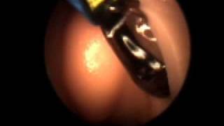 Balloon Sinuplasty for Chronic Sinusitis [upl. by Etezzil]