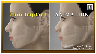 Chin Implant Animation Video  How is a chin implant inserted [upl. by Eiramanin]