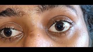 Complete Bilateral Ophthalmoplegia Video [upl. by Canter]