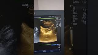 Hemorrhagic Cyst in Lt Ovary Ultrasound [upl. by Pillsbury]